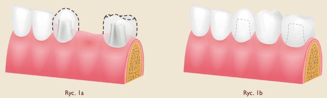Implanty zębowe - Stomatologia Boramed Warszawa - grafika obrazująca potencjalne implanty